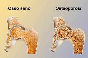 osteoporosi19141014_ml